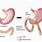 Loop Gastric Bypass
