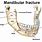 Mandible Fracture Types