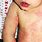 Measles-Mumps Rubella Book