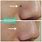 Mole Removal On Nose
