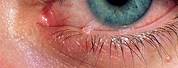 Molluscum Contagiosum On Eyelid
