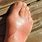 Nerve Damage Foot Pain