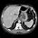 Normal Liver CT Scan