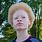 OCA1 Albinism