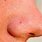 Open Pores On Nose
