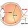 Optic Disc Blind Spot