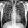 PCP Pneumonia Chest X-Ray