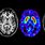 Parkinson's Disease Brain MRI