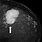 Phyllodes Tumor Mammogram