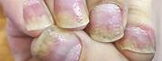 Psoriasis Nail Disease