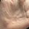 Scabies On Palm of Hand