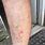 Scabies Rash Legs