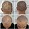 Scalp Alopecia