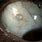 Scleral Cyst