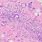 Sclerosing Adenosis Histology