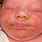 Seborrhea Infant