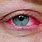 Severe Pink Eye