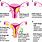 Stage 1B Endometrial Cancer