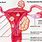 Submucosal Uterine Fibroid