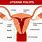 Symptoms of Polyps in Uterus