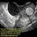 Teratoma Ovary Ultrasound