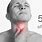 Throat Cancer Lesions