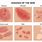 Types of Skin Diseases Eczema