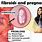 Uterine Fibroids Pregnancy