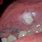Verrucous Carcinoma Oral Cavity