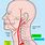 Vertebral Artery Occlusion Symptoms