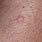 Warts On Stomach