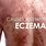 What Is Eczema Rash