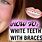 Whiten Teeth with Braces