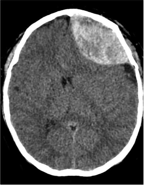 Low-Dose Aspirin and the Risk of Stroke and Intracerebral Bleeding in ...