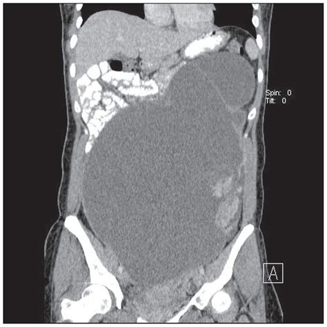 Borderline mucinous cystic ovarian tumor with mural nodules ...