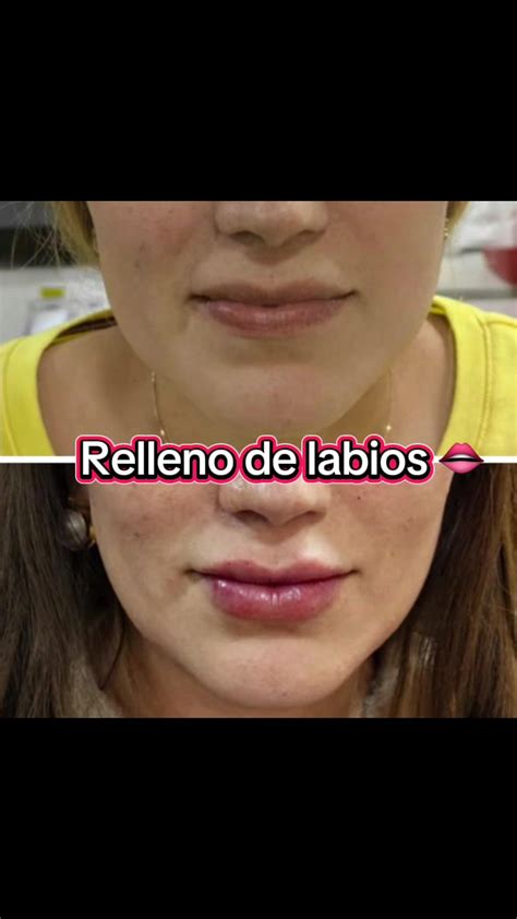 Relleno de labios #botox #rellenolabios #armonizacionfacial #medicinae ...
