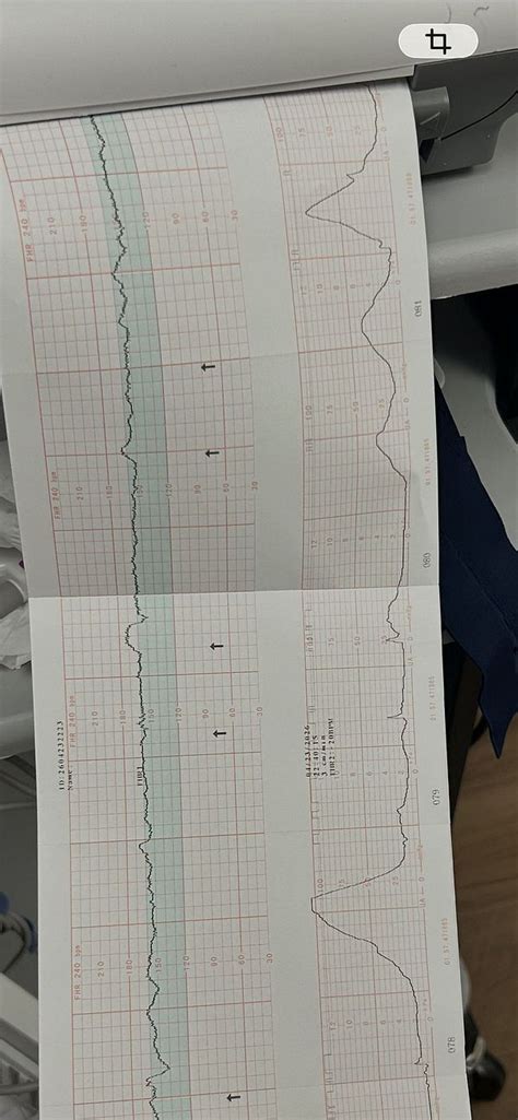 Told to ignore contractions and move on. Any similar experiences ...