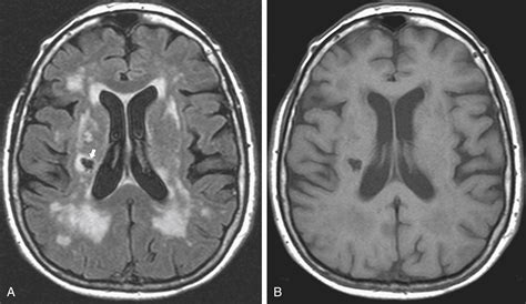 Understanding Immature Granulocytes • The Blood Project - Face Surgery