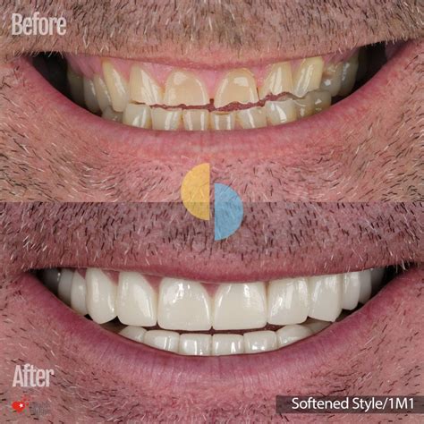 Worn Teeth Before After Pictures At Smile Dental Turkey