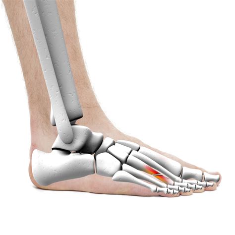 5 causes of foot pain after metatarsal stress fracture healed - Doc On The Run Podcast - Podcast ...