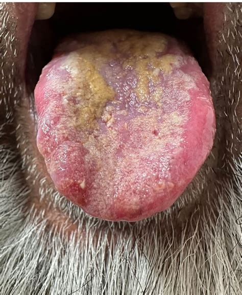 Pemphigus Vulgaris Autoimmune... - Cancer Care by Dr.Salam | Facebook