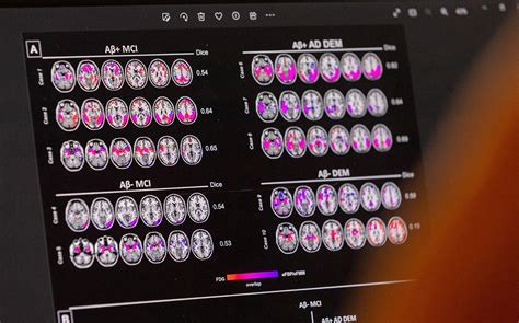 Lecanemab: Will NHS ever pay for new era of Alzheimer's drugs? - BBC News