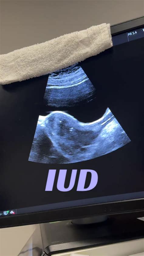 IUD Transabdominal #uterus #sonographyschool #sonographer #educational ...