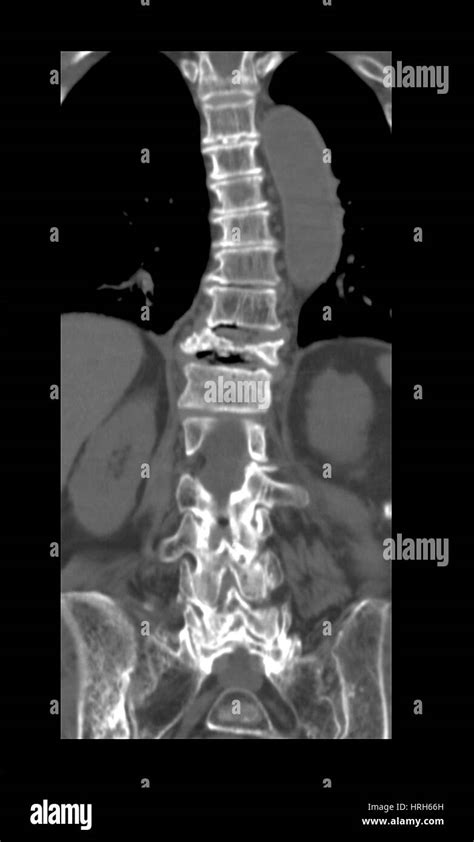 Compression technique Black and White Stock Photos & Images - Alamy