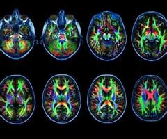 Neuro Lecture 5 Flashcards | Quizlet