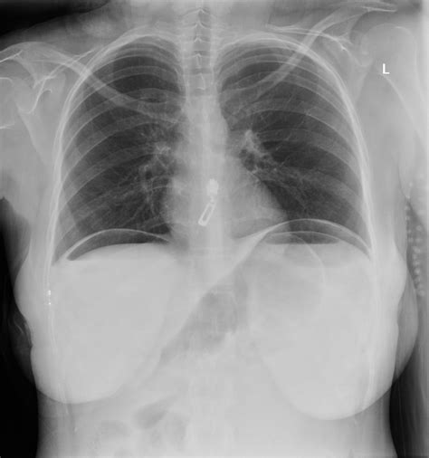Pneumoperitoneum | Radiology Case | Radiopaedia.org