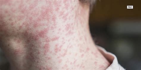 Possible measles exposure in Ashtabula County