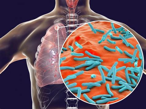 Camden Co. resident hospitalized with tuberculosis