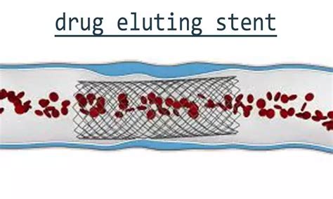 Short-Course DAPT Non-Inferior After Firehawk Stent Implantation: Study