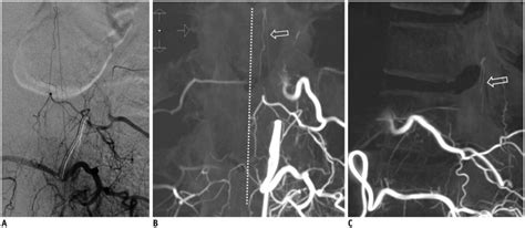 Spinal Dural Arteriovenous Fistula: Imaging Features and Its Mimics - PMC